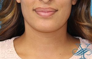 After Kybella Dr. Yegiyants, Santa Barbara, CA