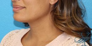 After Kybella Dr. Yegiyants, Santa Barbara, CA