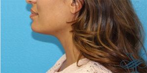 After Kybella Dr. Yegiyants, Santa Barbara, CA