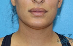 Before Kybella Dr. Yegiyants, Santa Barbara, CA