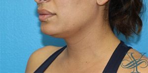 Before Kybella Dr. Yegiyants, Santa Barbara, CA