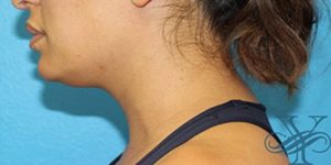 Before Kybella Dr. Yegiyants, Santa Barbara, CA