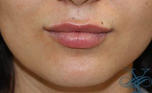 after lip fillers Dr. Yegiyants, Santa Barbara, CA