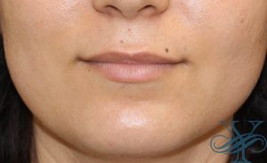 BEfore lip augmentation Dr. Yegiyants, Santa Barbara, CA