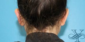 After otoplasty Dr. Yegiyants, Santa Barbara, CA