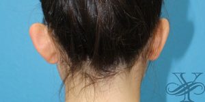 Before otoplasty Dr. Yegiyants, Santa Barbara, CA