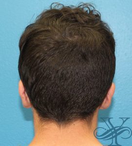 After otoplasty Dr. Yegiyants, Santa Barbara, CA