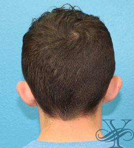 Before otoplasty Dr. Yegiyants, Santa Barbara, CA