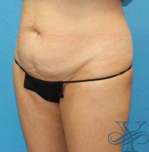 Before sculpsure Dr. Yegiyants, Santa Barbara, CA