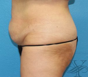 Before sculpsure Dr. Yegiyants, Santa Barbara, CA