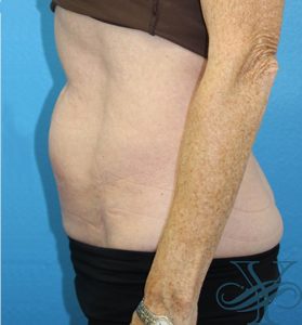 After sculpsure Dr. Yegiyants, Santa Barbara, CA