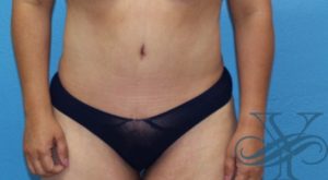 Before abdominoplasty Dr. Yegiyants, Santa Barbara, CA