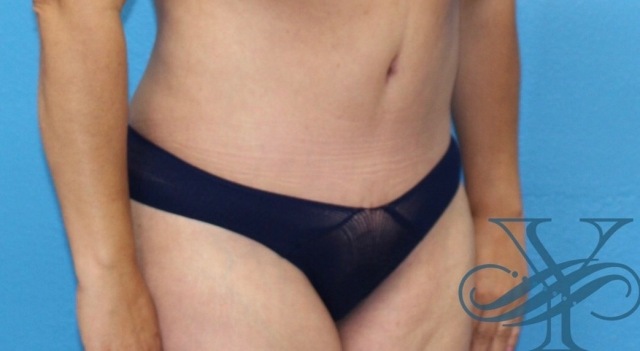 Before abdominoplasty Dr. Yegiyants, Santa Barbara, CA