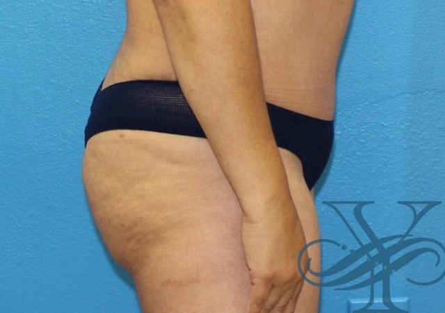 Before abdominoplasty Dr. Yegiyants, Santa Barbara, CA