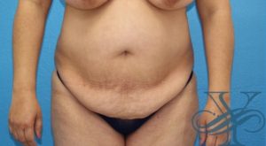 Before abdominoplasty Dr. Yegiyants, Santa Barbara, CA