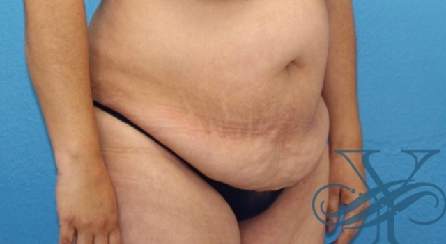 Before abdominoplasty Dr. Yegiyants, Santa Barbara, CA