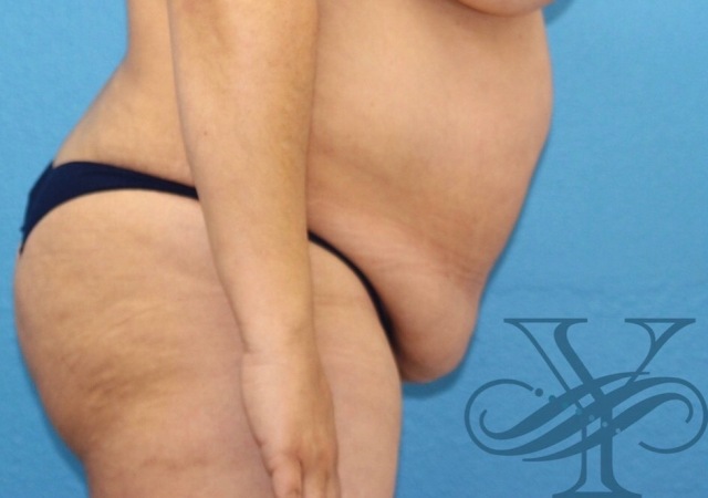 Before abdominoplasty Dr. Yegiyants, Santa Barbara, CA