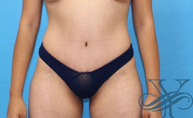 After abdominoplasty Dr. Yegiyants, Santa Barbara, CA