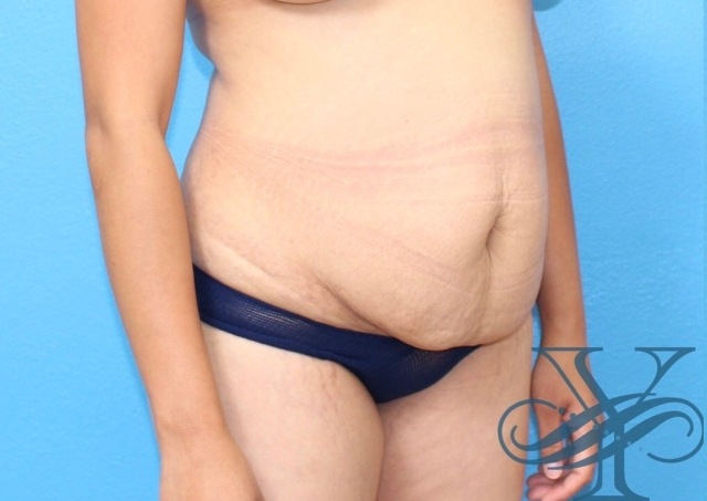 Before abdominoplasty Dr. Yegiyants, Santa Barbara, CA