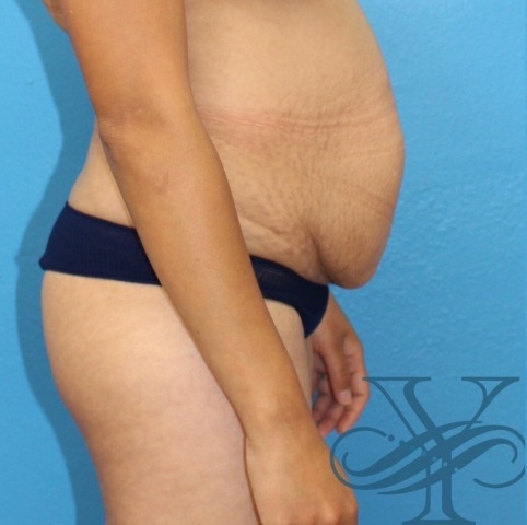 Before abdominoplasty Dr. Yegiyants, Santa Barbara, CA