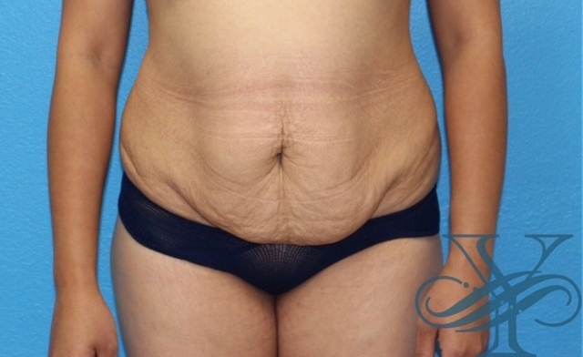 Before abdominoplasty Dr. Yegiyants, Santa Barbara, CA