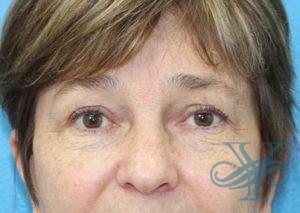 After blepharoplasty Dr. Yegiyants, Santa Barbara, CA