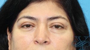 Before blepharoplasty Dr. Yegiyants, Santa Barbara, CA