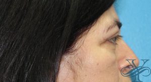 Before blepharoplasty Dr. Yegiyants, Santa Barbara, CA