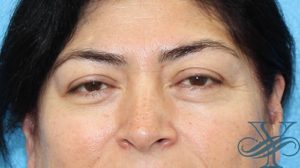 Before blepharoplasty Dr. Yegiyants, Santa Barbara, CA