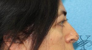 After blepharoplasty Dr. Yegiyants, Santa Barbara, CA