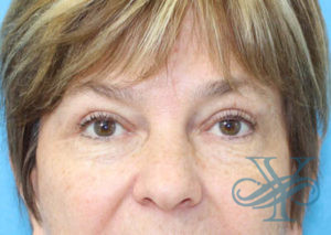 After blepharoplasty Dr. Yegiyants, Santa Barbara, CA