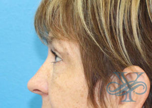 After blepharoplasty Dr. Yegiyants, Santa Barbara, CA