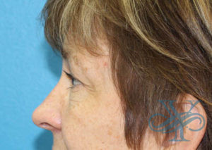 Before blepharoplasty Dr. Yegiyants, Santa Barbara, CA