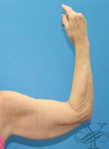 Before brachioplasty Dr. Yegiyants, Santa Barbara, CA