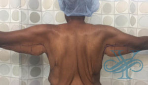 Before brachioplasty Dr. Yegiyants, Santa Barbara, CA