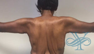 After brachioplasty Dr. Yegiyants, Santa Barbara, CA