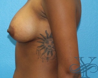 After breast augmentation Dr. Yegiyants, Santa Barbara, CA
