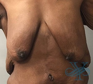 Before breast lift Dr. Yegiyants, Santa Barbara, CA