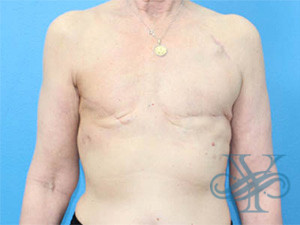 Breast reconstruction Dr. Yegiyants, Santa Barbara, CA