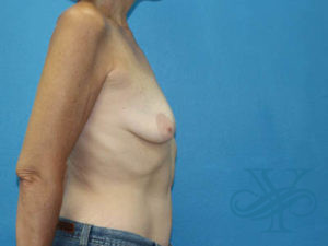Before breast reconstruction Dr. Yegiyants, Santa Barbara, CA