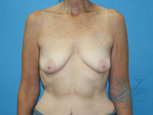Before breast reconstruction Dr. Yegiyants, Santa Barbara, CA