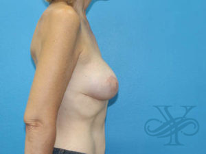After breast reconstruction Dr. Yegiyants, Santa Barbara, CA