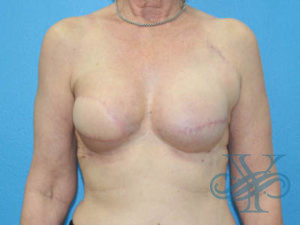 After breast reconstruction Dr. Yegiyants, Santa Barbara, CA