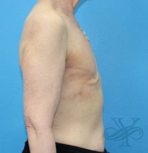 Before breast reconstruction Dr. Yegiyants, Santa Barbara, CA