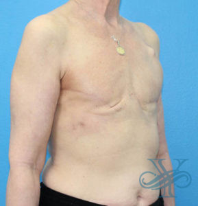 Before breast reconstruction Dr. Yegiyants, Santa Barbara, CA