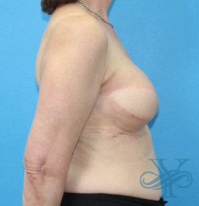 After breast reconstruction Dr. Yegiyants, Santa Barbara, CA