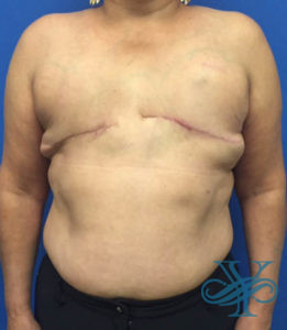 Before breast reconstruction Dr. Yegiyants, Santa Barbara, CA