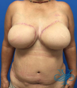 After breast reconstruction Dr. Yegiyants, Santa Barbara, CA