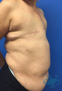 Before breast reconstruction Dr. Yegiyants, Santa Barbara, CA