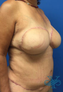 Before breast reconstruction Dr. Yegiyants, Santa Barbara, CA
